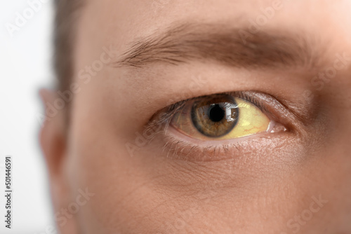 Fototapeta Naklejka Na Ścianę i Meble -  Man with yellow eyes, closeup. Hepatitis symptom
