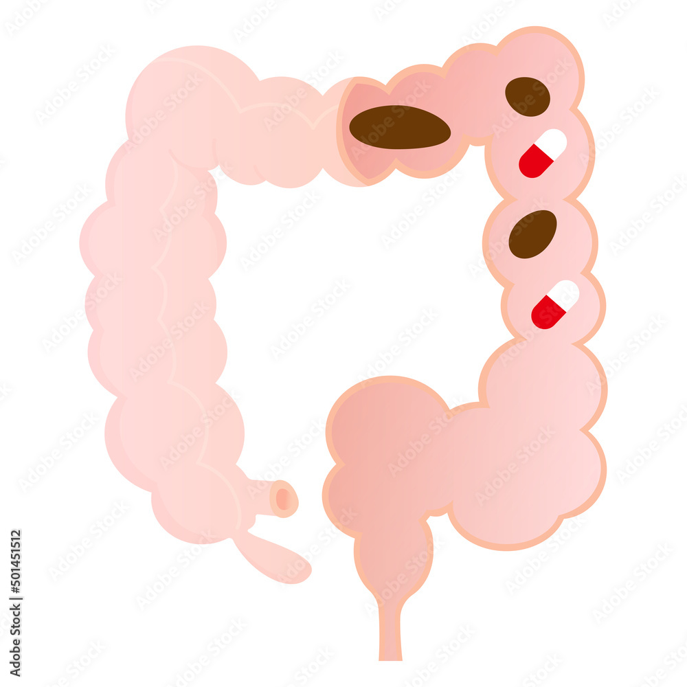 Vector illustration of drug-induced constipation. Vector illustration of drug-induced constipation.