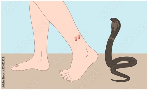 Snake Bite First Aid care non venomous anti venom serum hand leg king cobra treat kit death injury help safe call pain blood healing prevent coral fangs step poster grabbing splint limb sign tongs