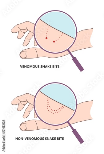 Snake Bite First Aid care non venomous anti venom serum hand leg king cobra treat kit death injury help safe call pain blood healing prevent coral fangs step poster grabbing splint limb sign tongs