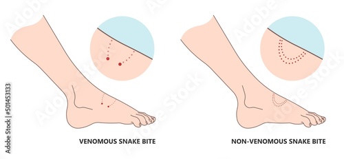 Snake Bite First Aid care non venomous anti venom serum hand leg king cobra treat kit death injury help safe call pain blood healing prevent coral fangs step poster grabbing splint limb sign tongs