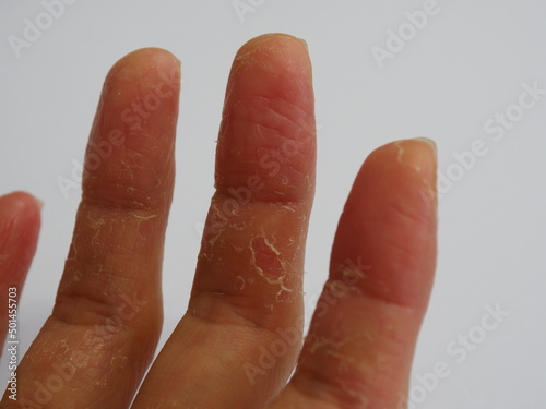peeling finger skin on focus background