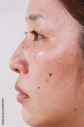 woman's face, half face portrait with blemish large pores black dots