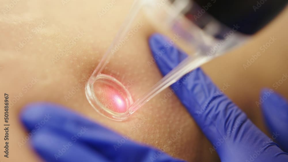 Laser cosmetic surgery and skin resurfacing in dermatology. Beauty laser technician performing skin resurfacing procedure in a medical spa and beauty clinic. Laser pulses cleanse the skin