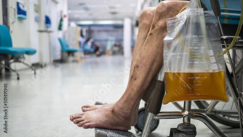 Fotografie, Obraz Asian elderly man patient sitting on wheelchair with urine bag in the hospital w