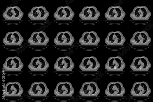 Overview of a computed tomography scan of a patient with a lung tumor