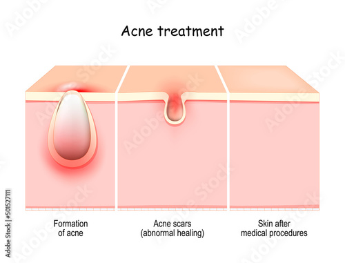 Acne treatment. Cross section of a skin
