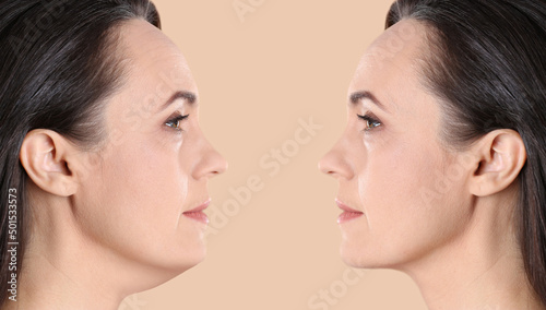 Double chin problem. Collage with photos of mature woman before and after plastic surgery procedure on beige background