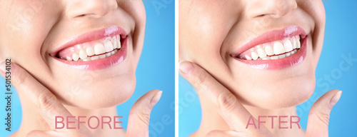 Young woman before and after gingivoplasty procedure on light blue background, closeup. Banner design photo