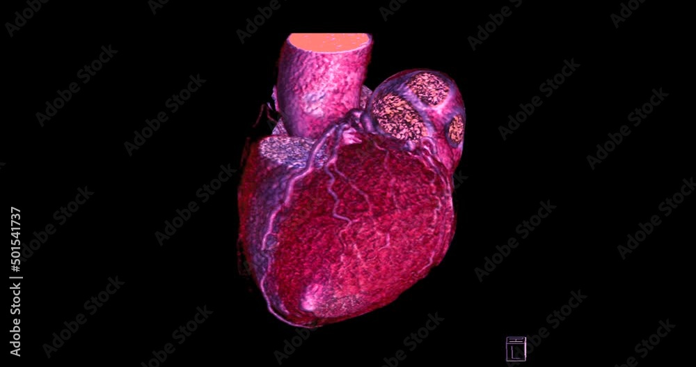 CTA Coronary artery 3D rendering turn around on the screen for ...