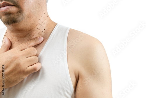 Middle aged man in white vest point to Skin Tags or Acrochordon on his neck photo