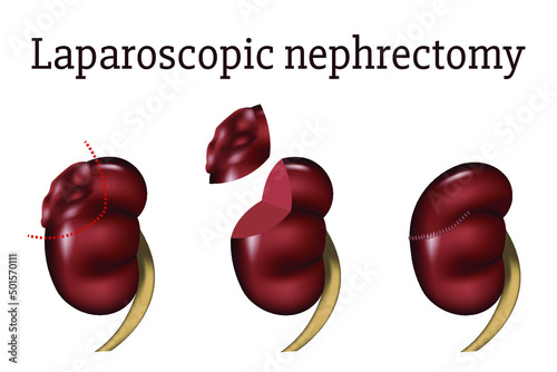 laparoscopic nephrectomy. Kidney surgery with tumor removal. Step by step diagram. Medical poster. Vector illustration