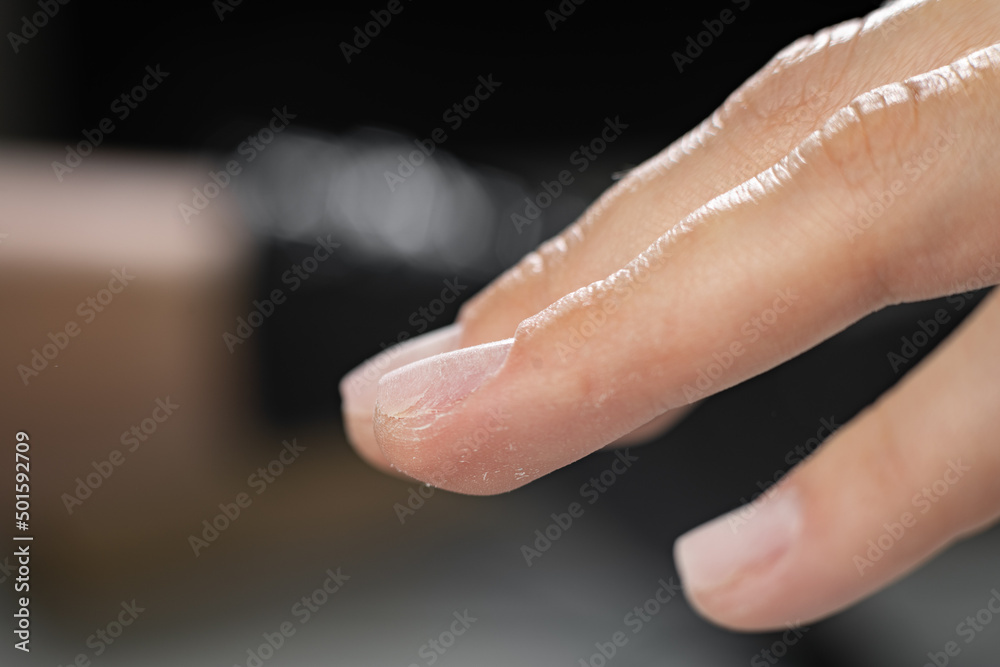 Close-up of female fingers with sawed off nails, hand preparation for manicure, thin nail plate treatment, beautiful hand - obrazy, fototapety, plakaty 