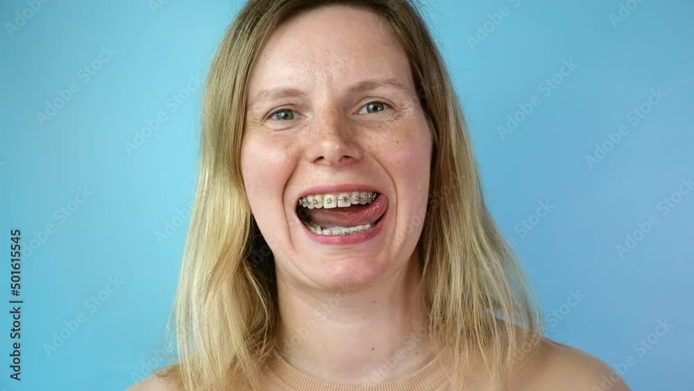 Young woman with dental braces laughing isolated on blue colour background. Studio. Cute lovely girl with metal braces on white clear teeth smiling in clinic. Close Up. Positive Emotion. Stomatology. Young woman with dental braces laughing isolated on blue colour background. Studio. Cute lovely girl with metal braces on white clear teeth smiling in clinic. Close Up. Positive Emotion. Stomatology.