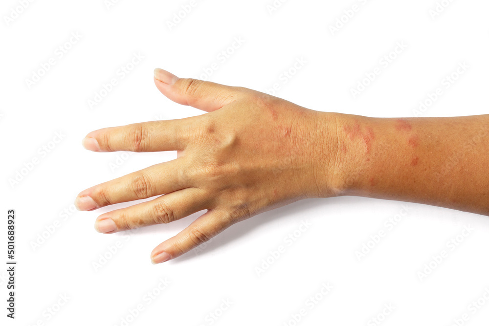 Woman's arm with red blisters on the skin due to allergic rash isolated on white background included clipping path.