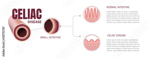 Illustration of part of the small intestine and what it looks like when you do not have celiac disease and when you do have celiac disease.
