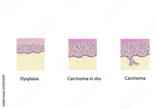 morphology of cervical cancer and cancerogenesis under a microscope, illustration, vector