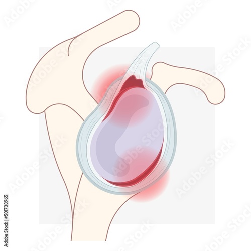 Bankart lesion slap tear bony hill sachs torn bone periosteal pain humerus cuff tendon aching range of motion arm Arthroscopy dislocated frozen trauma cavity disease inferior repair rim humeral photo