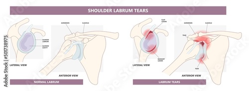 Bankart lesion slap tear bony hill sachs torn bone periosteal pain humerus cuff tendon aching range of motion arm Arthroscopy dislocated frozen trauma cavity disease inferior repair rim humeral