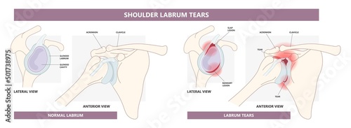 Bankart lesion slap tear bony hill sachs torn bone periosteal pain humerus cuff tendon aching range of motion arm Arthroscopy dislocated frozen trauma cavity disease inferior repair rim humeral photo