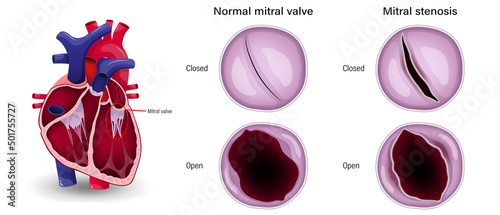 Valular heart disease. The difference of mitral stenosis and normal mitral valve. photo