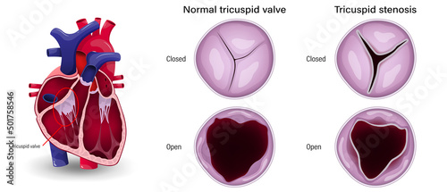 Valular heart disease. The difference of tricuspid stenosis and normal tricuspid valve. photo