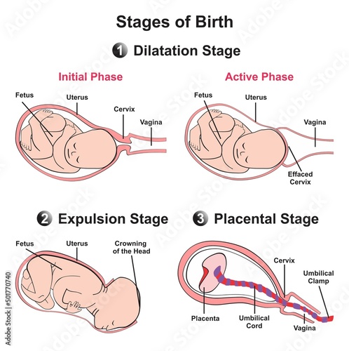 Stages of baby birth infographic diagram onset of labour flexion internal rotation of head extension then external rotation of head uterus immediately after birth vector illustration medical science
