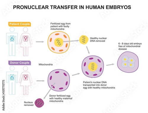 Pronuclear transfer in human embryo infographic diagram patient and donor couple mitochondria fertilized egg healthy DNA nucleus removed free of disease vector for medical science education