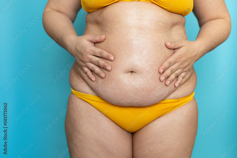 Overweight woman in yellow underwear rub sagging belly with hands closeup.  Doing abdominal massage and lifting for weight loss, blue background.  Anticellulite fat burning procedure for slim figure. Stock Photo
