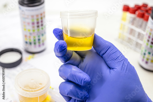 laboratorian hand with glove, performing EAS type urine test, Abnormal Sediment Elements. photo
