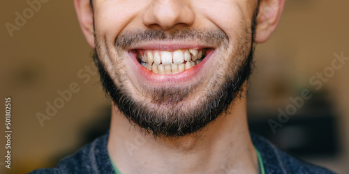 Εκτύπωση καμβά A man with bristles and an open mouth with uneven teeth