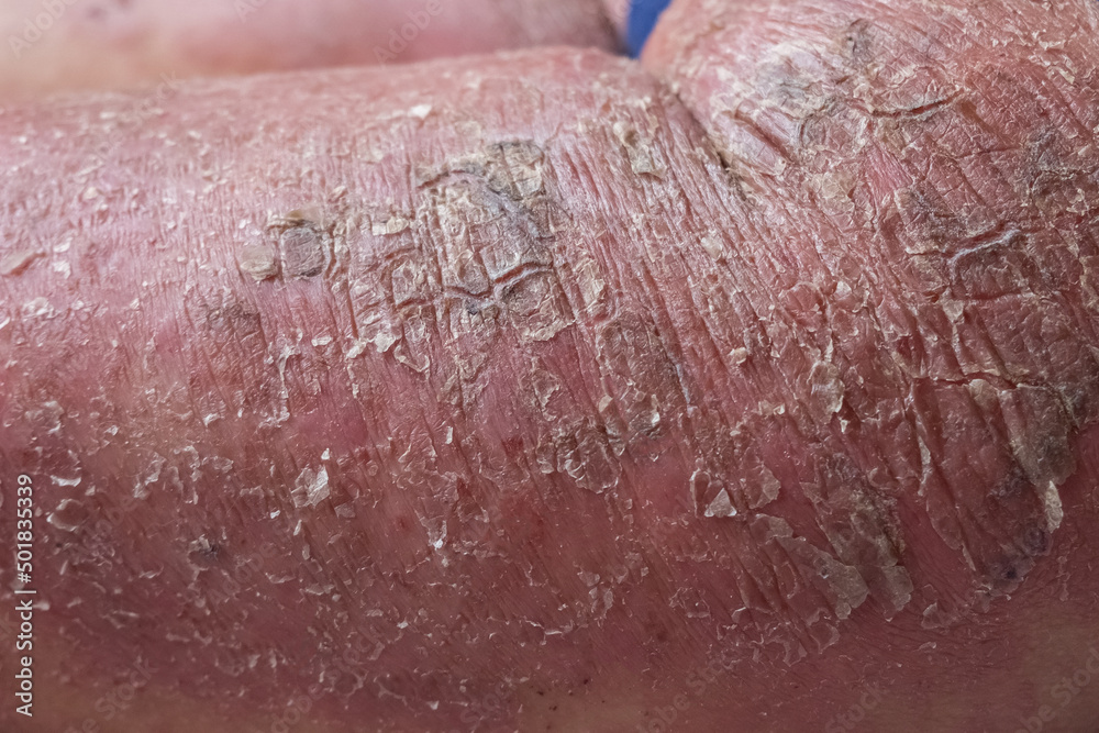Fototapeta premium Closeup of cracked and dry skin disease. Medical healthcare concept. Cosmetology dermatology concept.