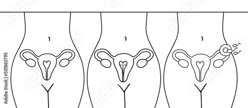 Fertilization icon. Uterus, sperm, insemination. Fertilization in the fallopian tube. The method of IUD contraception is not isolated.