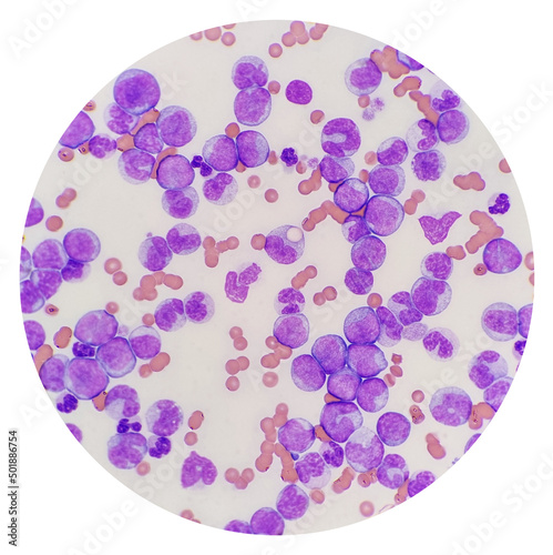 Microscopic images are acquired from blood smears of patients with Myeloid leukemia. Microscopic examination of the leukemic cells, an erythrophage in cat. Feline leukemia virus.
