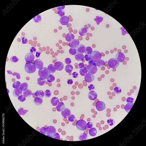 Microscopic images are acquired from blood smears of patients with Myeloid leukemia. Microscopic examination of the leukemic cells, an erythrophage in cat. Feline leukemia virus. photo