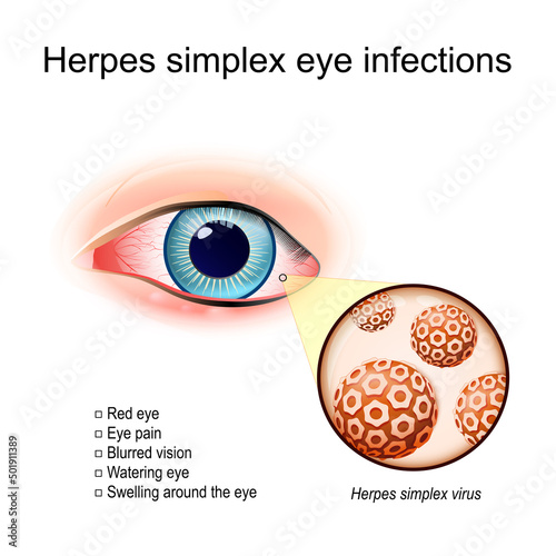 Herpes simplex eye infections. A red human's eye photo