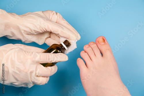 doctor disinfect the injured toenail. Hands in rubber gloves touch injured toenail in clinic. Diagnosis, treatment of mycosis of feet. Podiatrist treating ingrown toenail. Inflammation of the toes