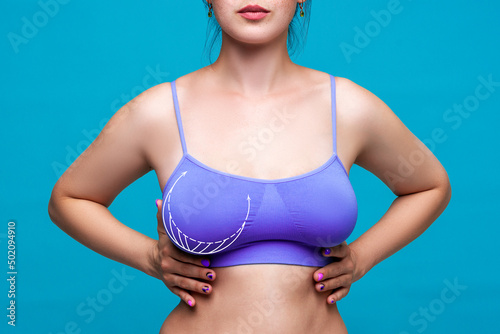 Breast asymmetry, female body with surgical lines, plastic surgery and aesthetic corrective mammoplasty concept photo