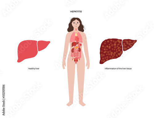 Autoimmune hepatitis disease