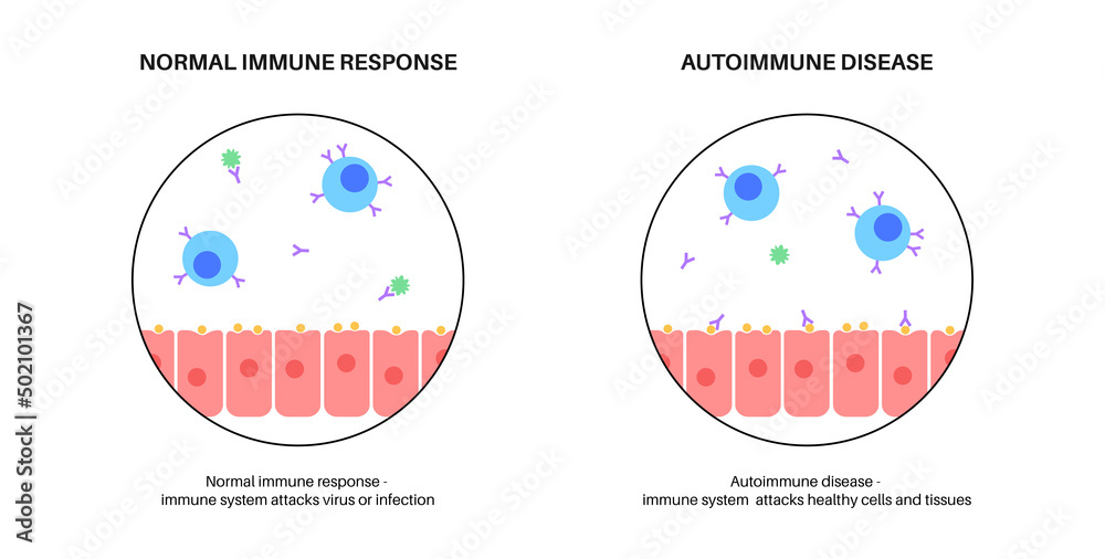 Autoimmune hepatitis disease Autoimmune hepatitis disease