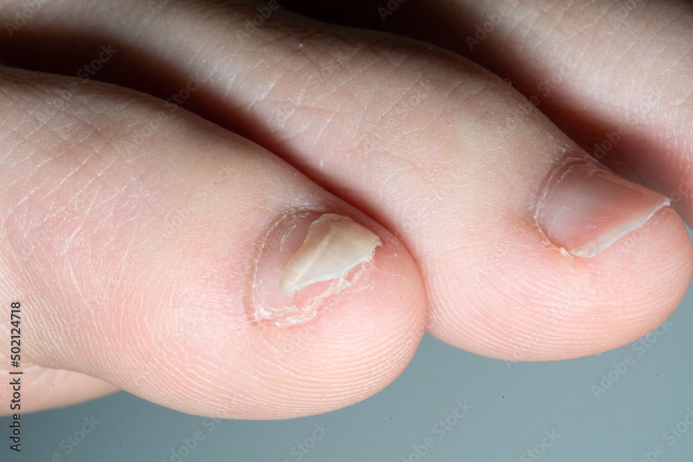 Broken little fingernail
