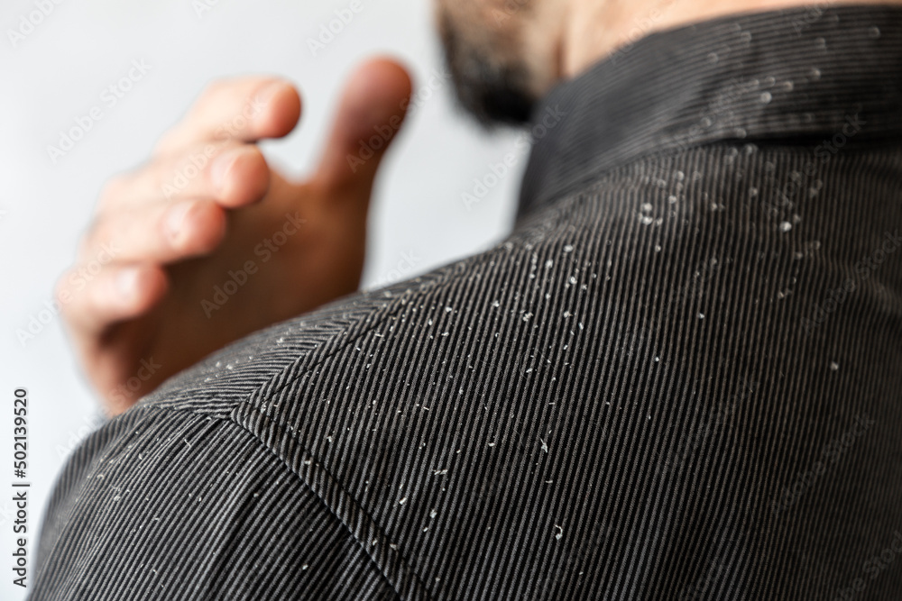 A bearded man in a black shirt shakes dandruff of his shoulder. Close-up. The concept of psoriasis and seborrheic dermatitis - obrazy, fototapety, plakaty 