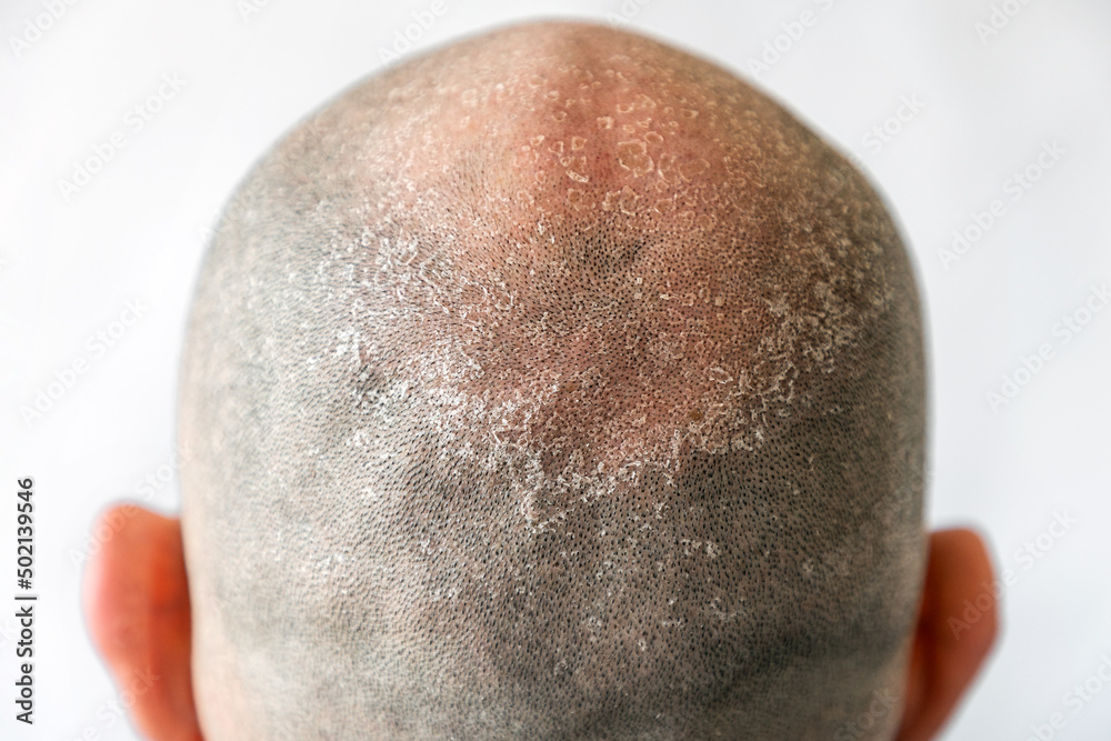 Males bald flaky head with dandruff closeup, back view. White background. The concept of