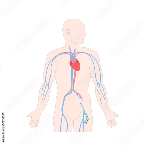 Femoral vein central venous access site shown on male body. Man with femoral central line catheter for hemodialysis, medication and fluids infusion. Medical vector illustration. photo