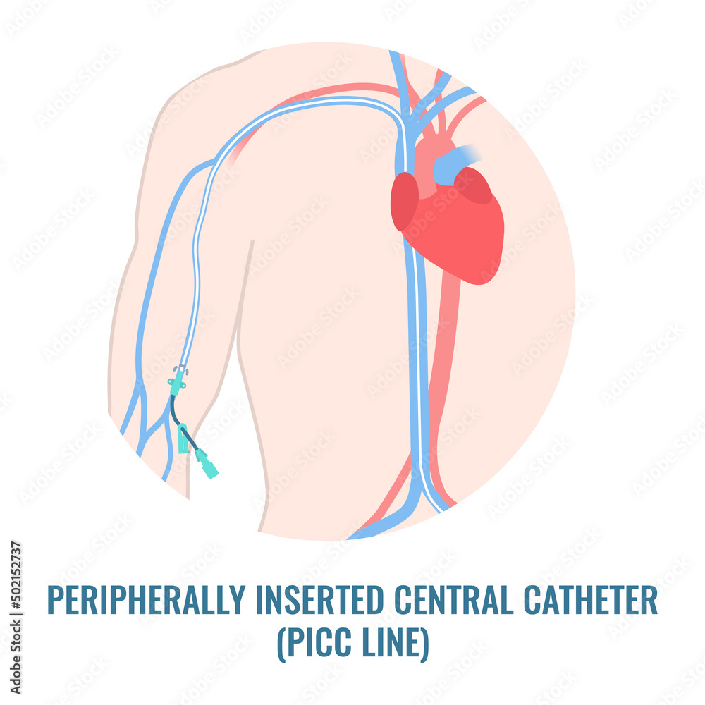 Naklejka Peripherally inserted central catheter placed in the upper arm