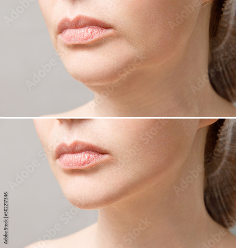 Obraz na plátně Female double chin before and after correction