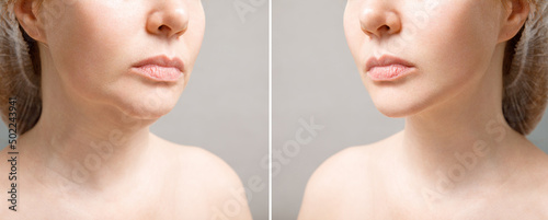 Female double chin before and after correction. Correction of the chin shape liposuction of the neck. The result of the procedure in the clinic of aesthetic medicine.