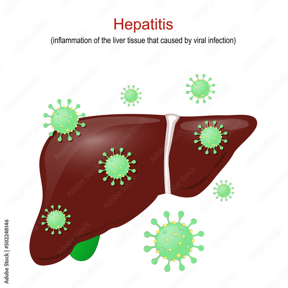 Hepatitis. inflammation of the liver tissue Stock Vector Adobe Stock