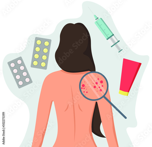 Problems with the skin of the back. Girl with a bare back with acne. Dermatologist appointment. Medicines for dermatitis, ointment for acne and fungus.