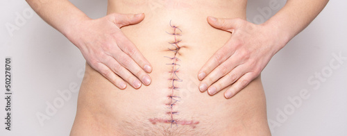 Surgical stitches. Surgical wound on body. Ileus abdomen surgery photo